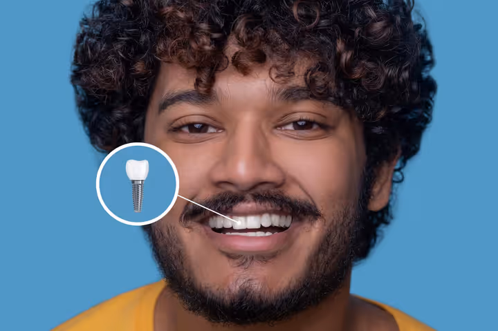 Everything You Need to Know About Screw in Teeth for Better Oral Health
