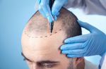 Hair Transplant Guide: Procedure Types, Recovery and Important Factors