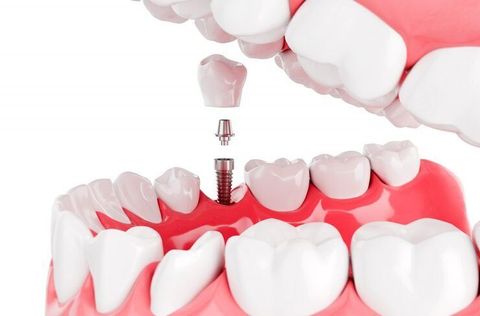 Dental Implants Guide: Implant Types, Placement Process, Materials and Care Considerations