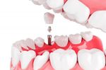 Dental Implants Guide: Implant Types, Placement Process, Materials and Care Considerations